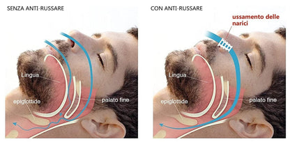 Set dispozitiv anti-sforait cu 8 dilatatoare nazale si gutiera de protectie bucala anti-bruxism, din silicon, pentru o respiratie mai buna si un somn mai linistit